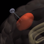 “اختراق كبير” وغير مسبوق في علاج السرطان